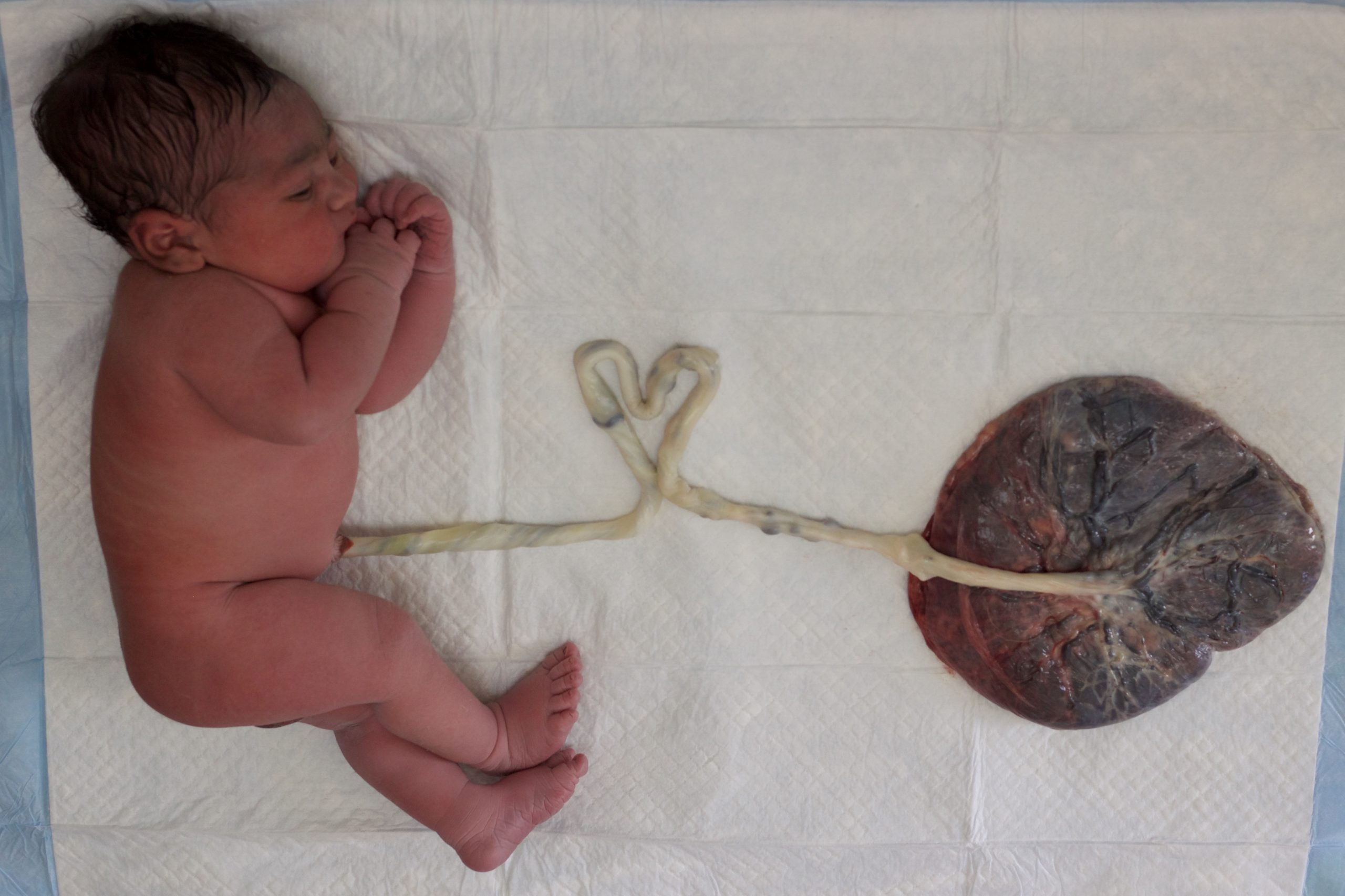 baby attached to placenta with heart