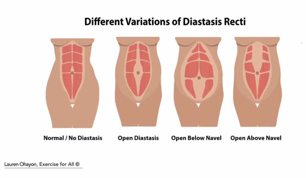 Diastasis recti variations